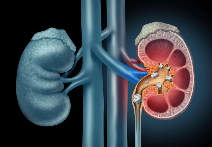 Kidneystone Analysis